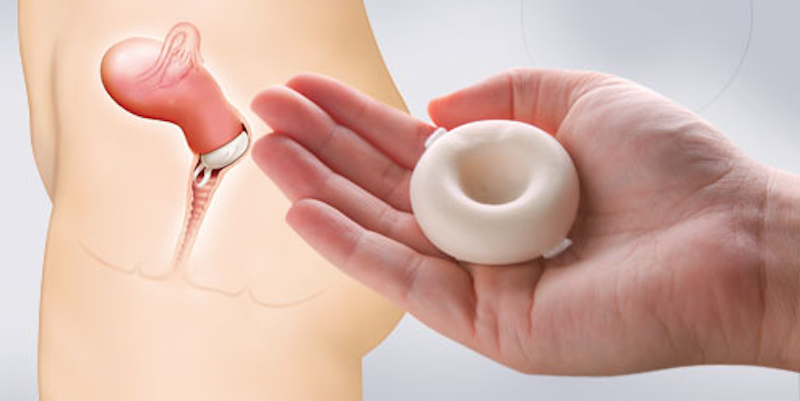 La-esponja-vaginal-al-igual-que-el-diafragma-y-el-capuchon-cervical-se-coloca-al-final-del-cuello-uterino